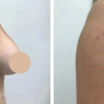 breast reduction in dubai