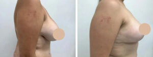 breast reduction in dubai