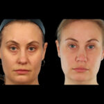 Under-Eye-Fillers in Dubai