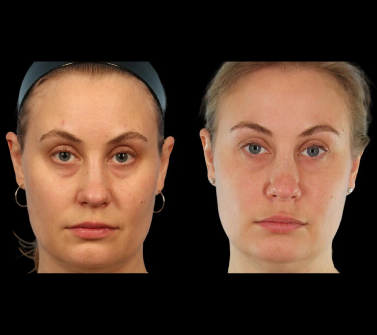 Under-Eye-Fillers in Dubai