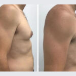 gynecomastia in dubai
