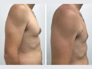 gynecomastia in dubai