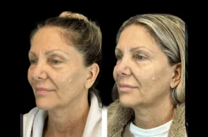 H9-Botox