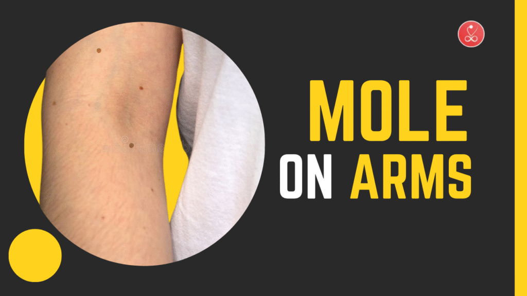Mole on Arms