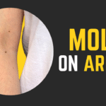 Mole on Arms