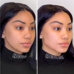 What to Expect Before and After Your Thread Lift in Dubai