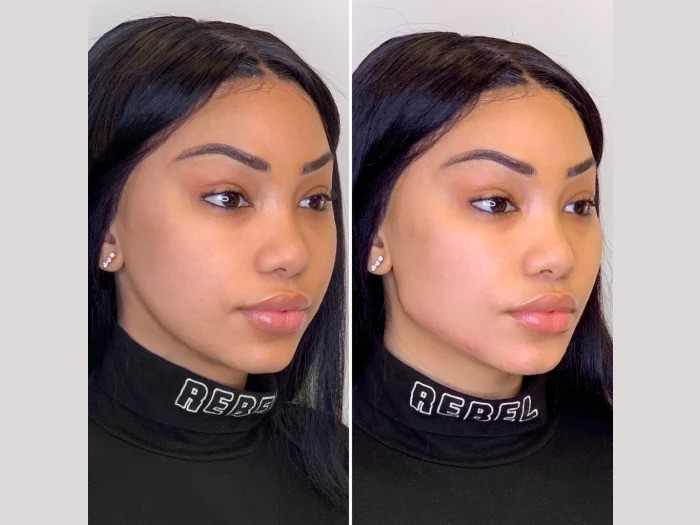 What to Expect Before and After Your Thread Lift in Dubai