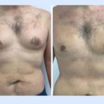 gynecomastia in dubai (1) (1)