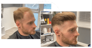 hair replacement for men near me