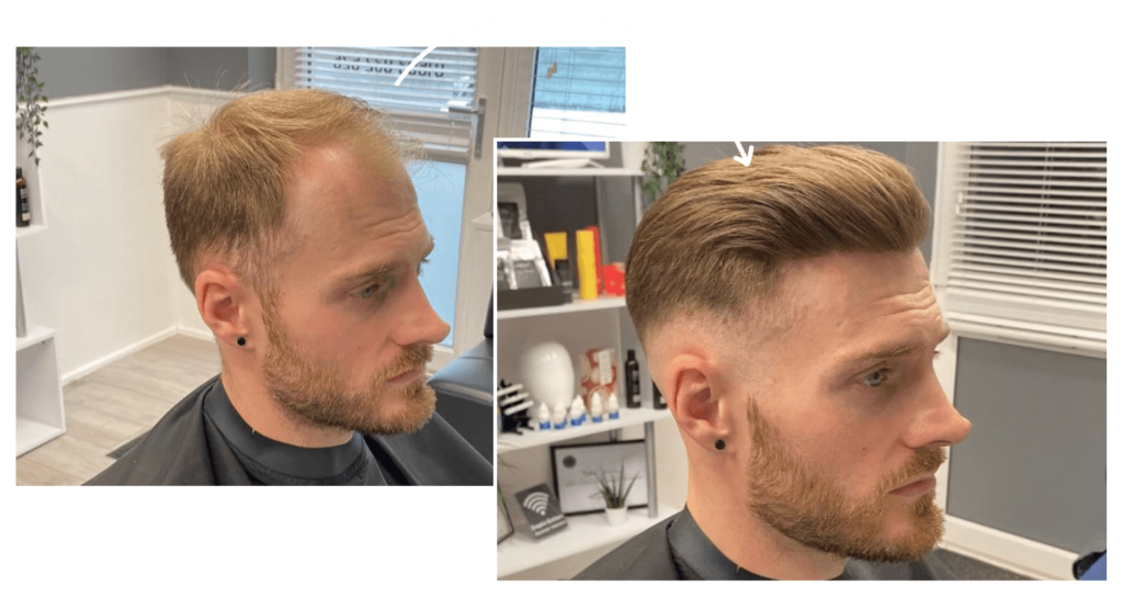 hair replacement for men near me