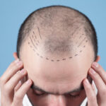 hair transplant clinic in ahmedabad, hair transplant clinic, hair transplant, Ahmedabad, hair transplant services