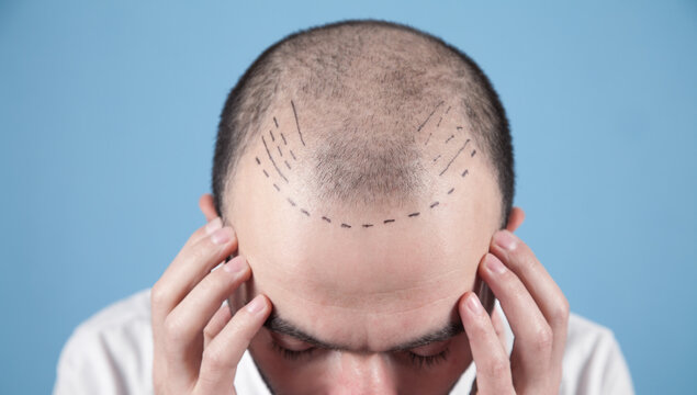 hair transplant clinic in ahmedabad, hair transplant clinic, hair transplant, Ahmedabad, hair transplant services
