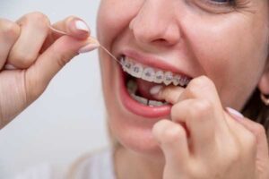 invisalign