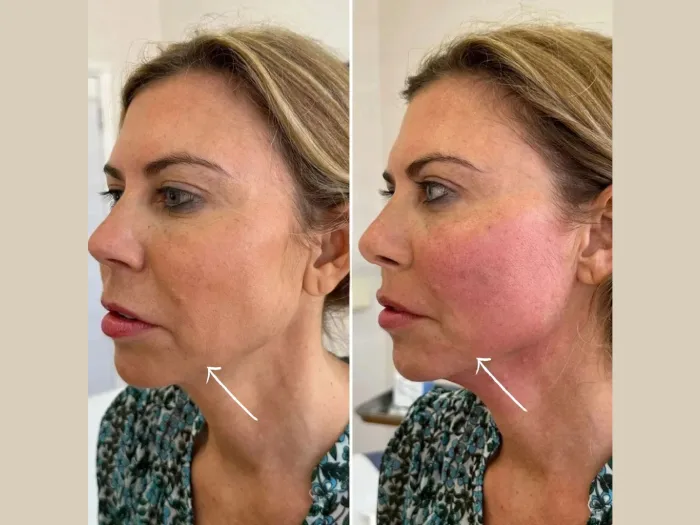 H1-Endolift