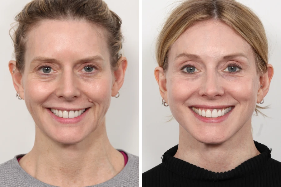 What Not to Do After Thread Lift Treatment in Dubai