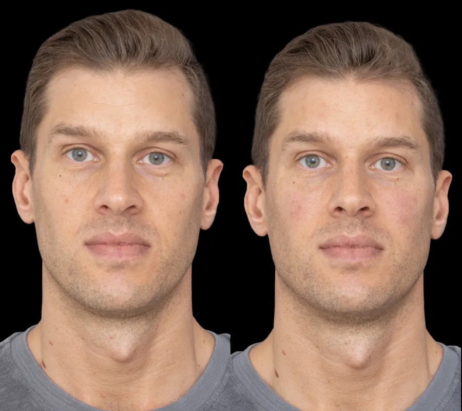 Under Eye Fillers in Dubai