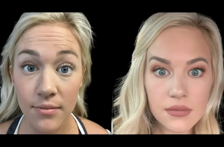 botox in dubai