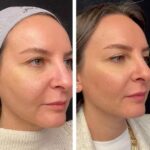 Mesotherapy in Dubai