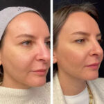 Mesotherapy in dubai