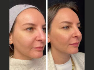 Mesotherapy in dubai