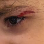 Advanced Ocular Trauma Services in Rohtak at Ishwar Eye Centre