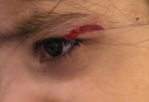 Advanced Ocular Trauma Services in Rohtak at Ishwar Eye Centre