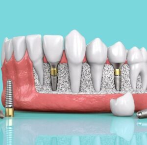Dental Implants