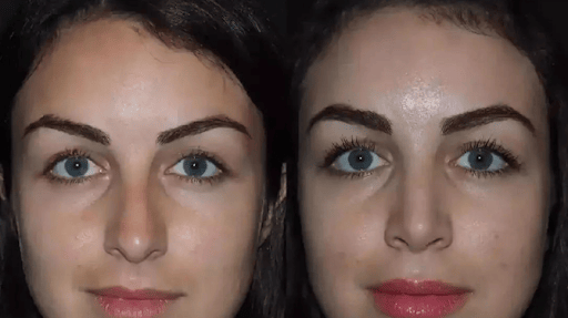 best septoplasty surgeon in dubai