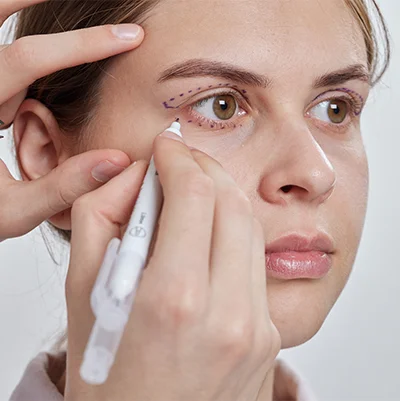 Blepharoplasty
