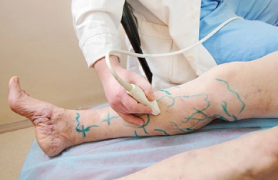 Deep Vein Thrombosis Treatment in Jaipur
