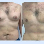 gynecomastia in Dubai