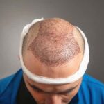 Hair Transplant in Dubai
