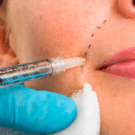 Juvederm Filler Dubai