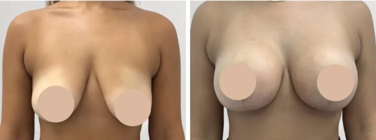 H1-Breast-reduction