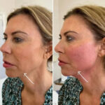 H1-Endolift