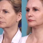 H2-Chemical-Peel