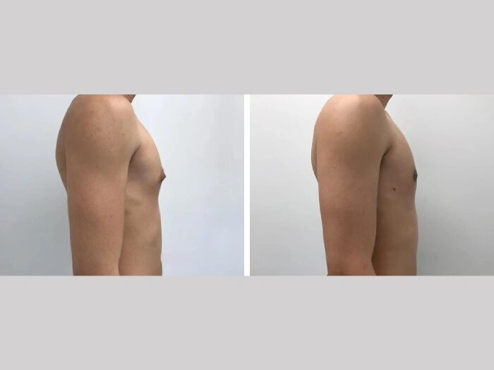 H2-Gynecomastia