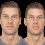 under eye fillers in duai
