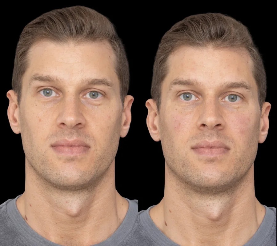 under eye fillers in duai