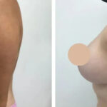 H33-Breast-reduction