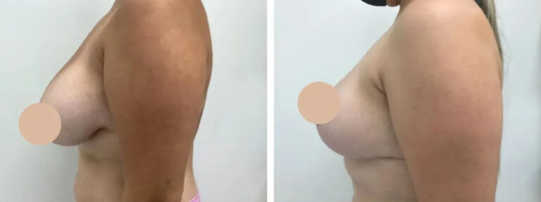 H33-Breast-reduction