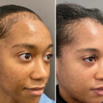 ChemicalPeel