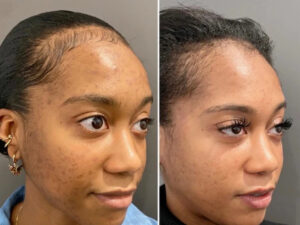 ChemicalPeel