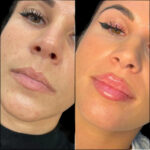 Dermal Fillers in Dubai