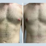 Avoiding Surgical Anxiety Before Gynecomastia in Dubai