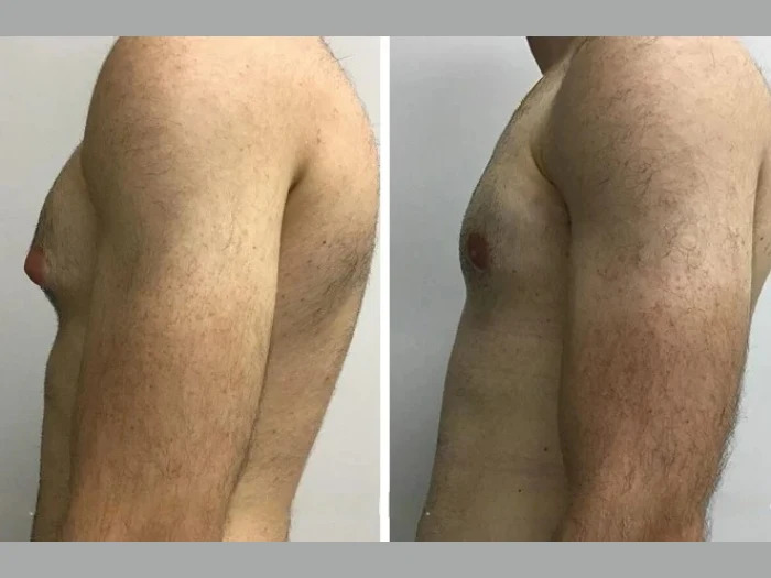 H9-Gynecomastia (1)