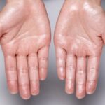 Hyperhidrosis Treatment in Dubai