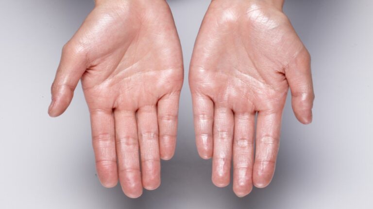 Hyperhidrosis Treatment in Dubai