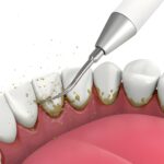 The Essential Role of Professional Dental Cleanings in Maintaining Long-Term Oral Health at Main Street Dentistry in Tupelo, MS