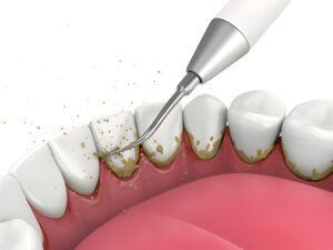 The Essential Role of Professional Dental Cleanings in Maintaining Long-Term Oral Health at Main Street Dentistry in Tupelo, MS